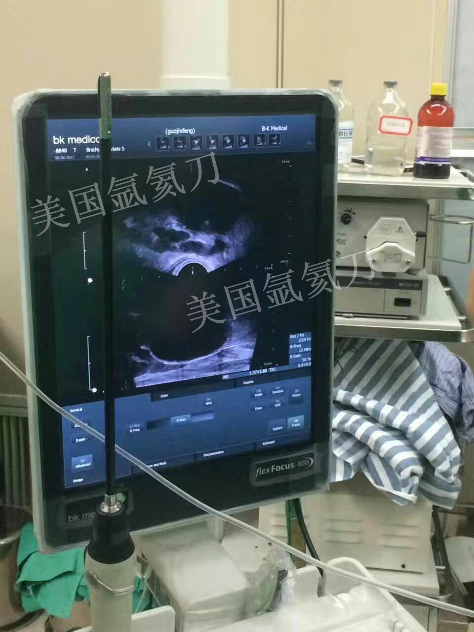 北京民航总医院泌尿外科前列腺癌氩氦刀冷冻手术