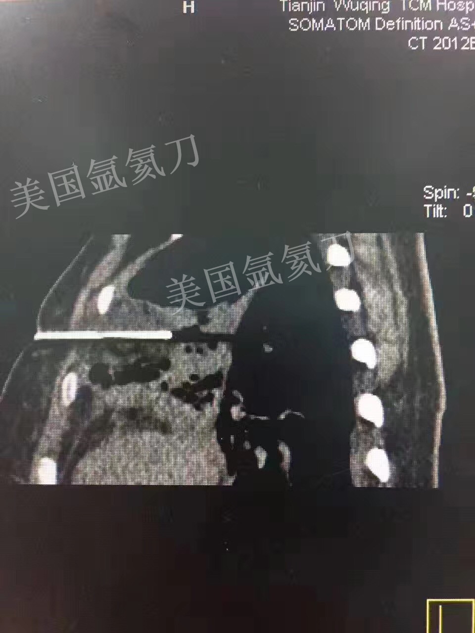 武清中医院胸外科三维薄层CT影像引导下左肺腺癌氩氦刀冷冻消融