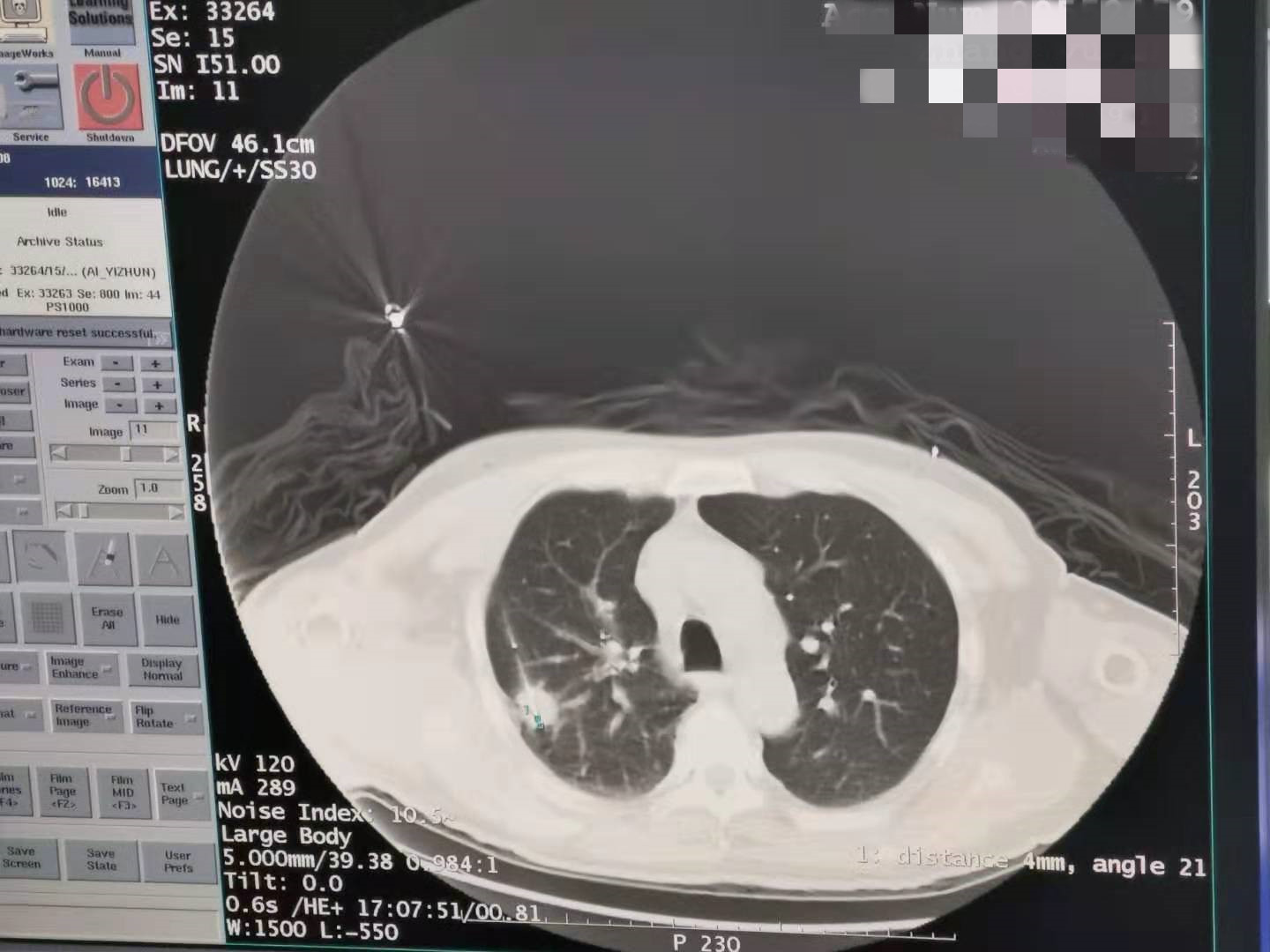 2019.8月肺部氩氦刀手术
