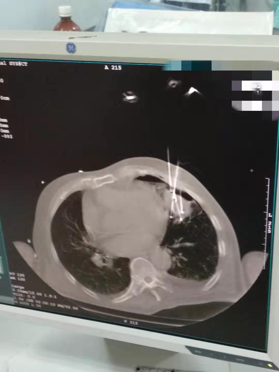 2019.9月肺部氩氦刀手术