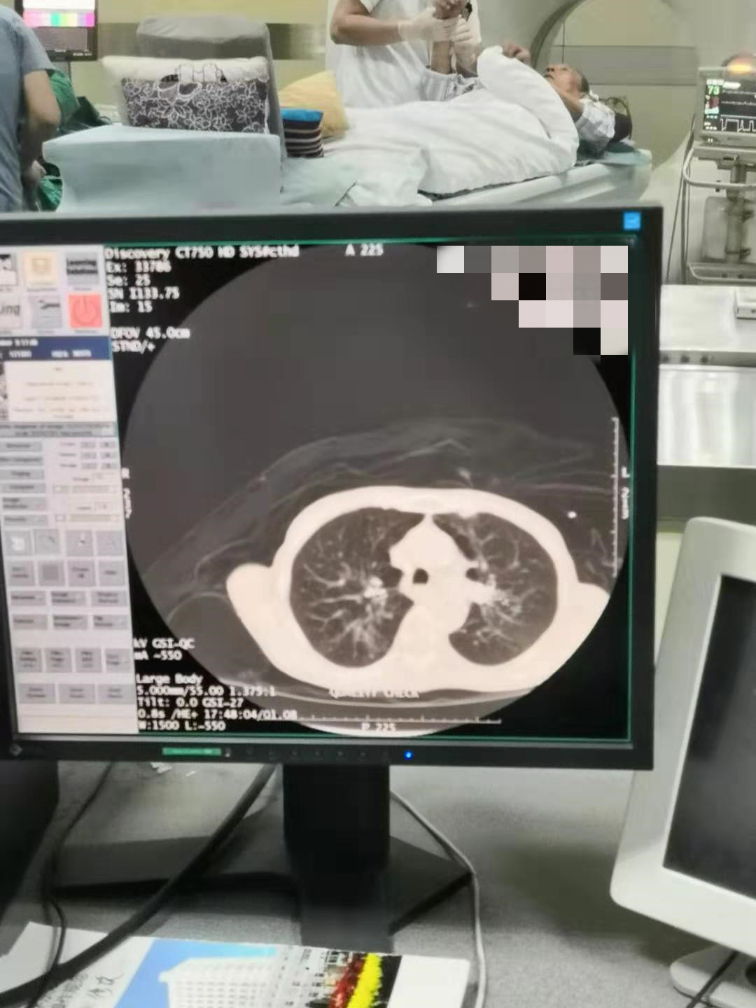 2019.10月肺部氩氦刀手术