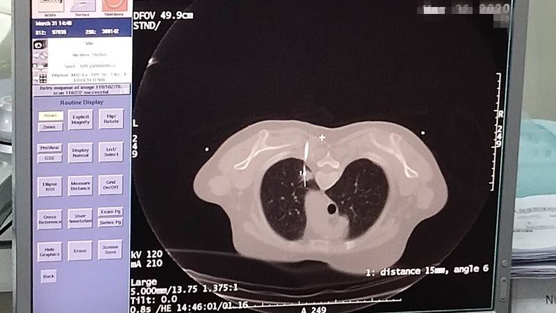 2020.3月肺部氩氦刀手术