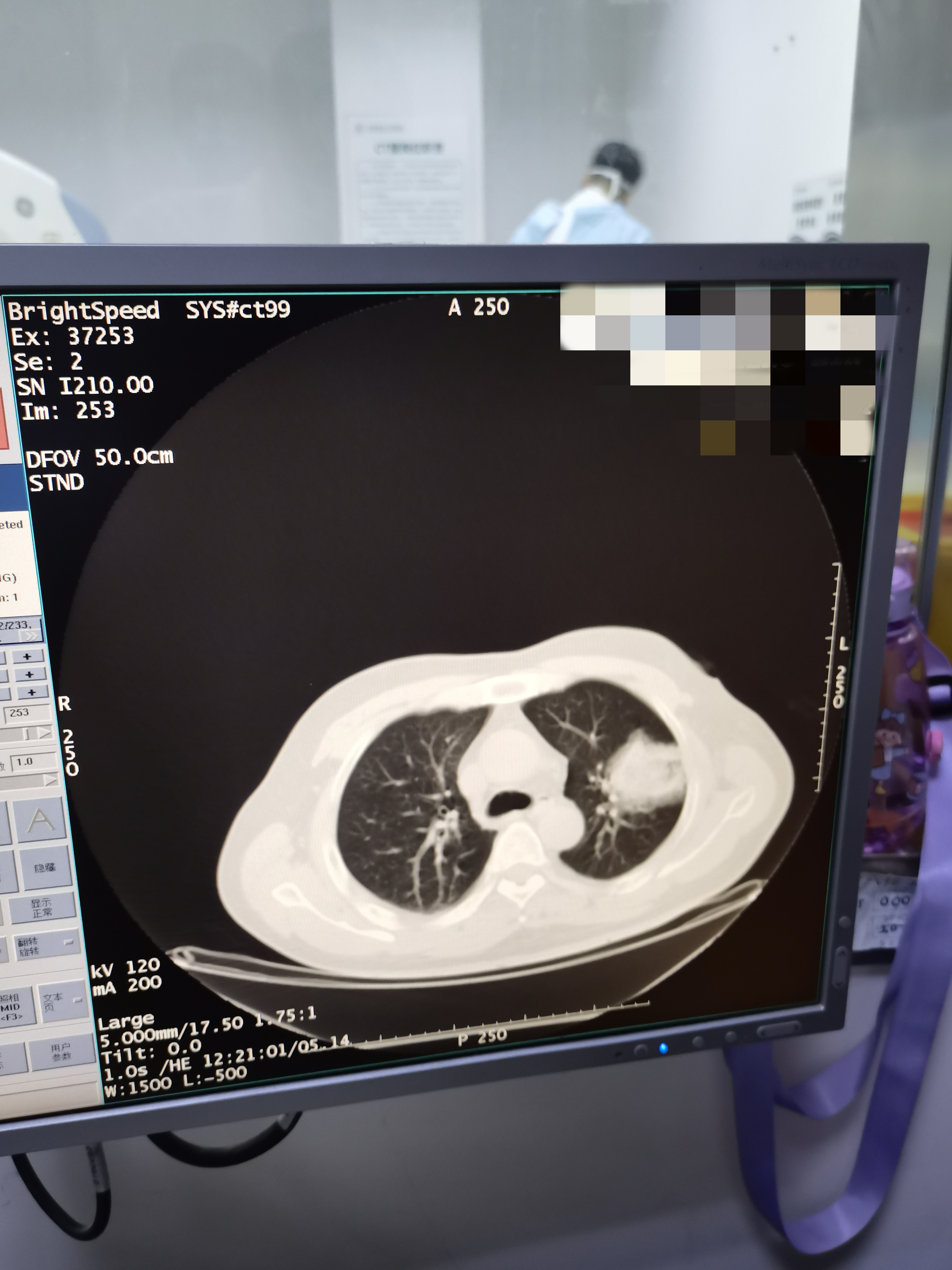 2021.11月肺部氩氦刀手术