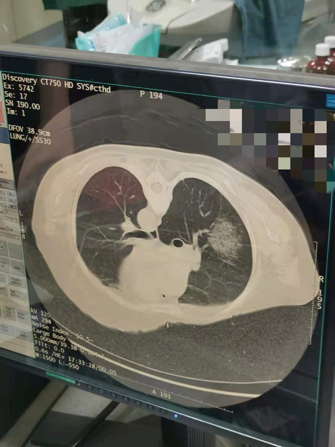 2021.7月肺部氩氦刀手术