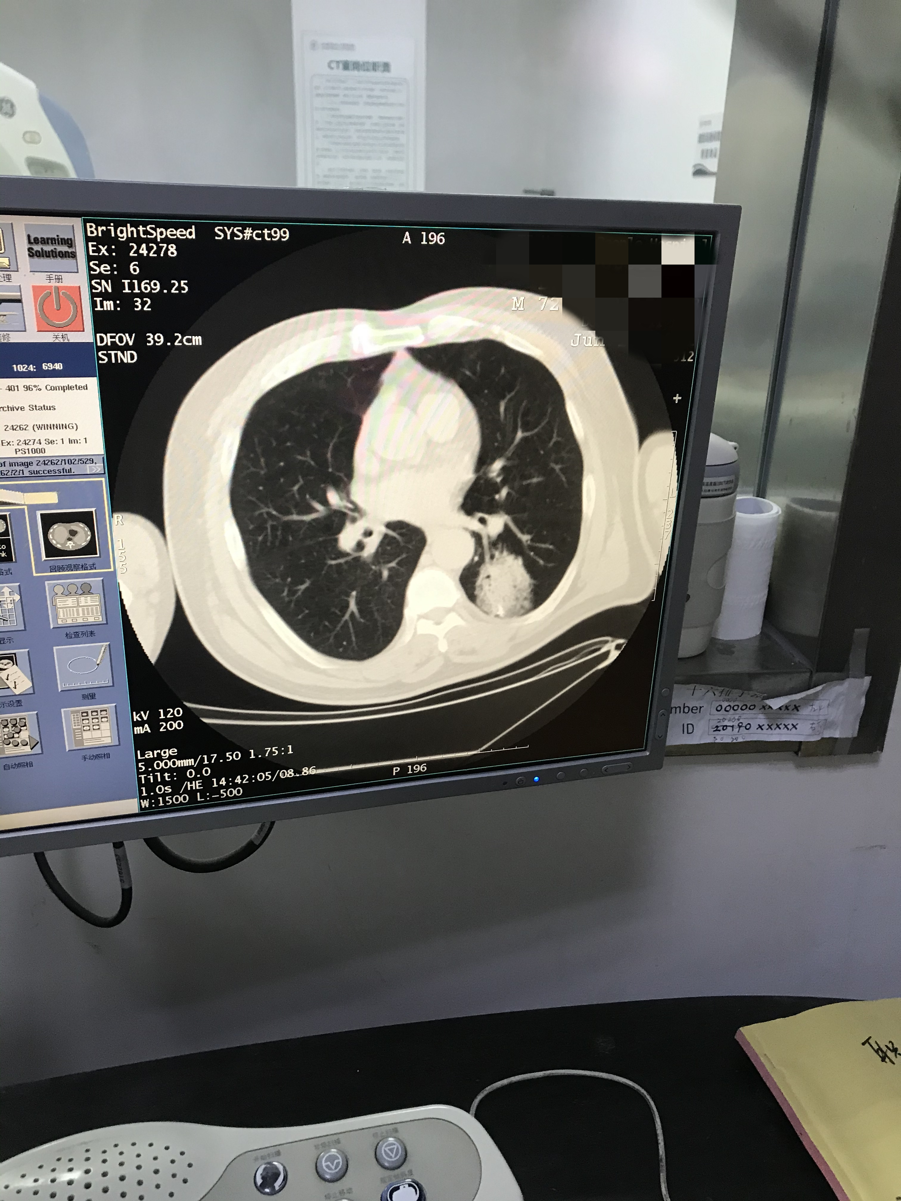 2021.6月肺部氩氦刀手术