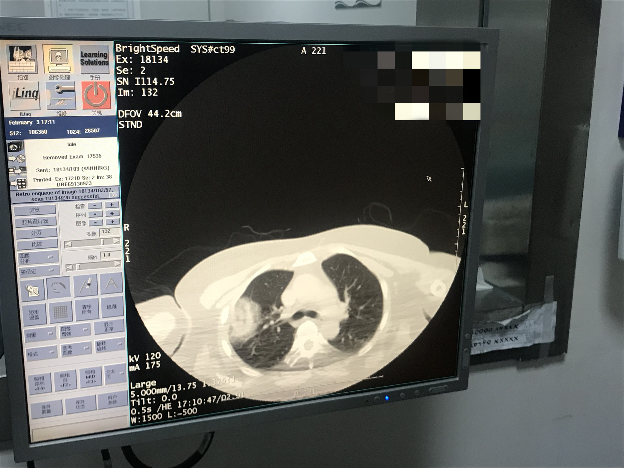 2021.2月肺部氩氦刀手术