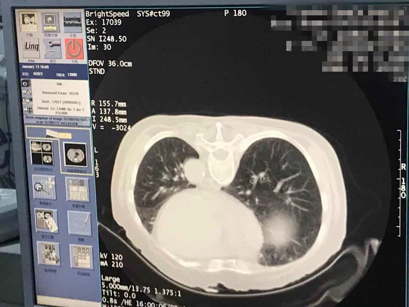 2021.1月肺部氩氦刀手术