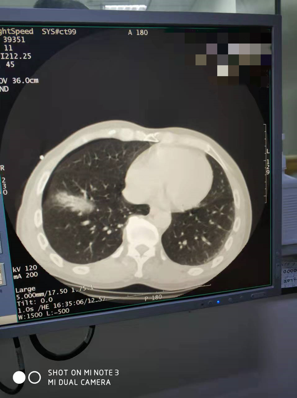 2022.1月肺部氩氦刀手术