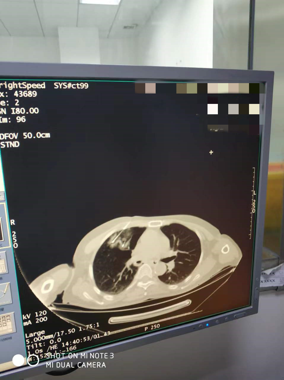 2022.4月肺部氩氦刀手术